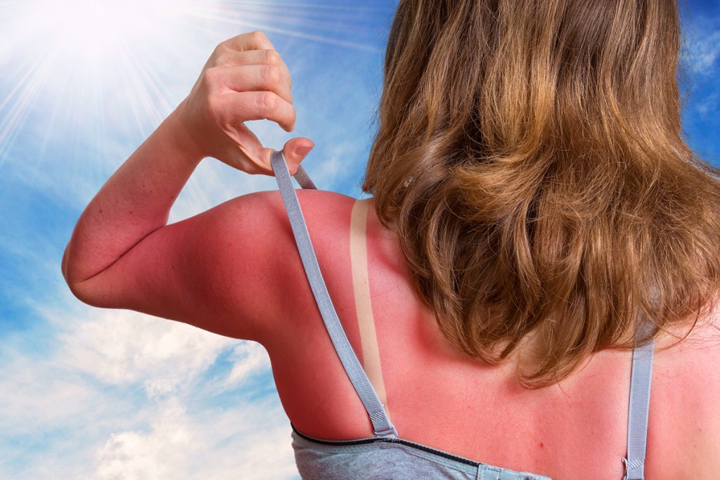 Woman With Sunburn